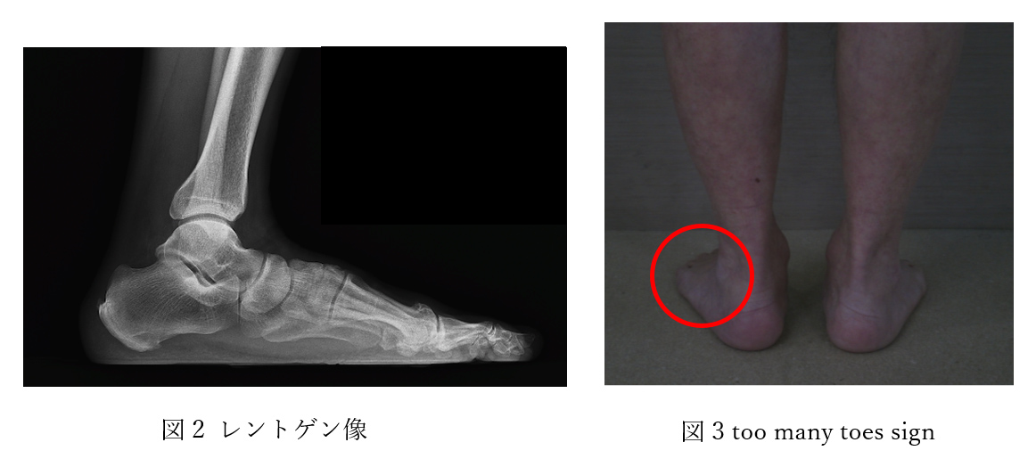 図2 レントゲン像／図3 too many toe sign
