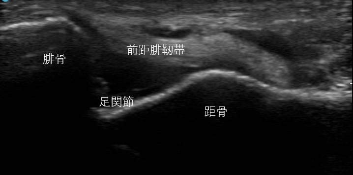 正常な前距腓靭帯のエコー像